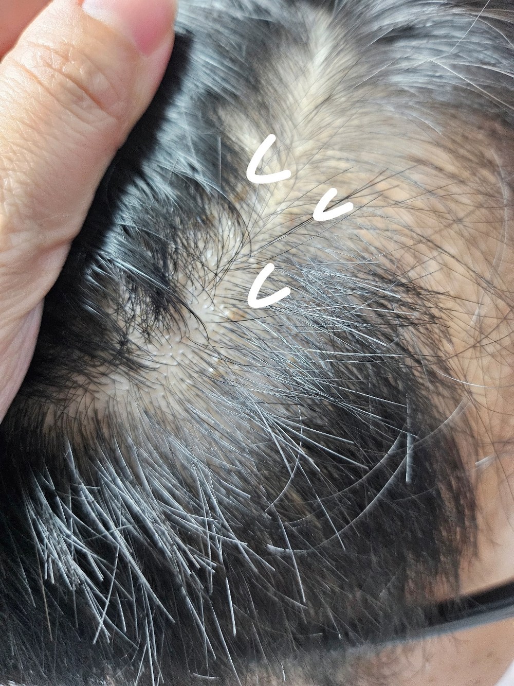 지루성 두피 특허성분 비듬 각질 케어 모모쿨 님트리 약산성 구매 후기 이미지